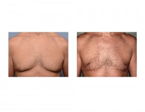 Mark Gynecomastia Reduction result front view