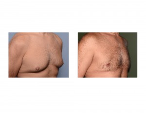 Mark Gynecomastia Reduction result oblique view