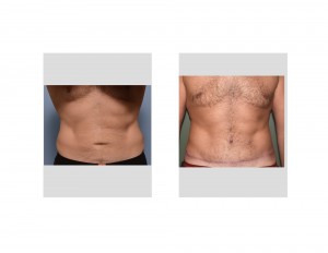 Mark Tummy Tuck result front view
