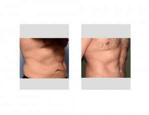 Mark Tummy Tuck result oblique view