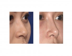 Nasal Implant Rhinoplasty result oblique view Dr Barry Eppley Indianapolis