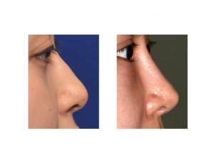 Nasal Implant Rhinoplasty result side view Dr Barry Eppley Indianapolis