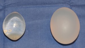 Saline vs Silicone Testicle Implant Dr Barry Eppley Indianapolis