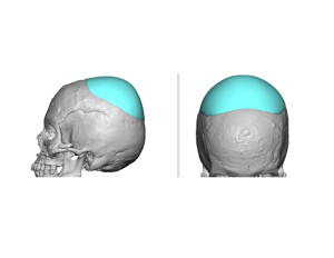 Skull Cap Implant design Dr Barry Eppley Indianapolis