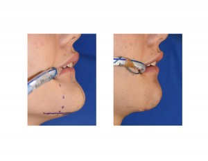 Submental Chin Reduction immediate result Dr Barry Eppley Indianapolis