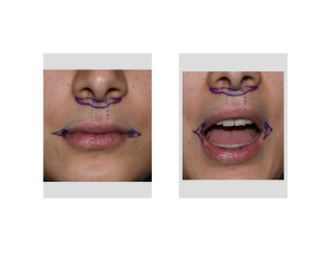 Subnasal Lip Lift and Mouth Widening Procedure design Dr Barry Eppley Indianapolis