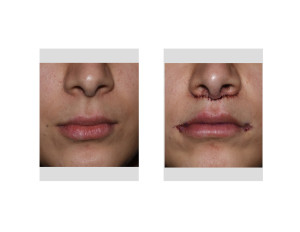 Subnasal Lip Lift and Mouth Widening Procedure immediate result front view Dr Barry Eppley Indianapolis