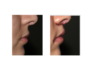 Subnasal Lip Lift and Mouth Widening Procedure immediate result side view Dr Barry Eppley Indianapolis