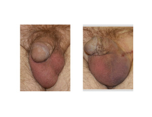 Testicular Implant Replacement immediate after result Dr Barry Eppley Indianapolis