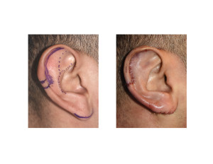 Vertical Ear Reduction result intraop Dr Barry Eppley Indianapolis