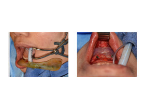 Custom Female Jawline Implant intraoperative insertion 2 Dr Barry Eppley Indianapolis
