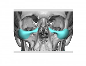 Custom Infraorbital-Malar Implants design Dr Barry Eppley Indianapolis