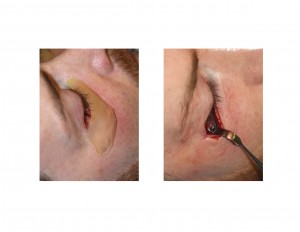 Custom Infraorbital-Malar Implants intraop view right side Dr Barry Eppley Indianapolis