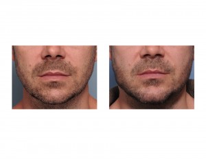 Custom Jawline Implant result front view Dr Barry Eppley Indianapolis