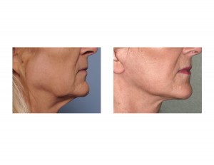 Female Lower Facelift result side view Dr Barry Eppley Indianapolis