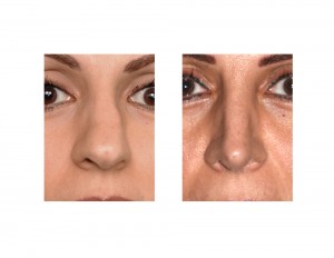 Middle Eastern Rhinoplasty result front view Dr Barry Eppley Indianapolis