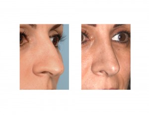 Middle Eastern Rhinoplasty result oblique view Dr Barry Eppley Indianapolis
