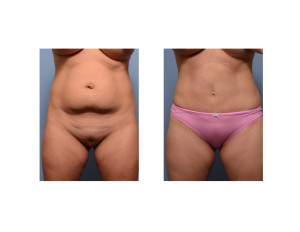 Mini Tummy Tuck with liposuction result front view