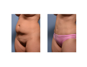 Mini Tummy Tuck with liposuction result obloique view