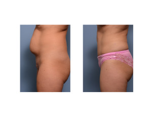 Mini Tummy Tuck withu liposuction result side view