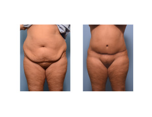 Realistic Extended Tummy Tuck result front view Dr Barry Eppley