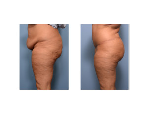 Realistic Extended Tummy Tuck result side view Dr Barry Eppley Indianapolis