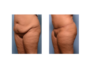 Realistic Tummy Tuck result oblique view Dr Barry Eppley Indianapolis