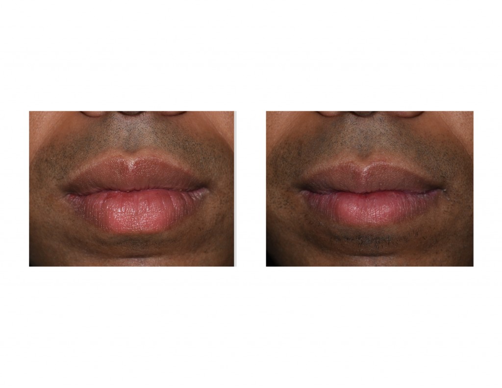 Lip Reduction Archives