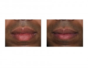 Upper and Lower Lip Reduction results Dr Barry Eppley Indianapolis