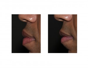 Upper and Lower Lip reduction results side view Dr Barry Eppley Indianapolis