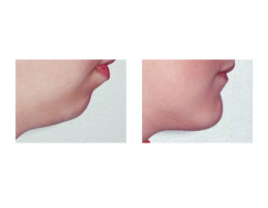 Vertical Lengthening Chin Implant result 1 Dr Barry Eppley Indianapolis