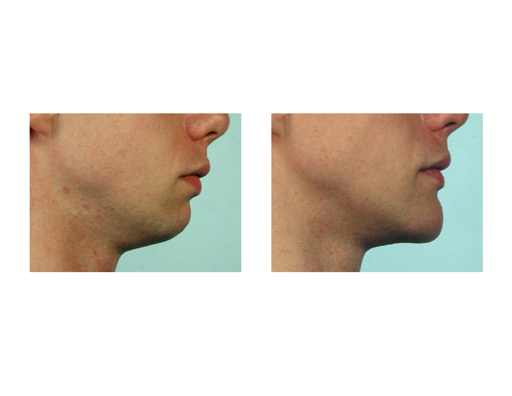 Vertical lengthening chin implant