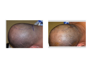 Adult Occipital Plagiocephaly Custom Skull Implant result intraop side view Dr Barry Eppley Indianapolis