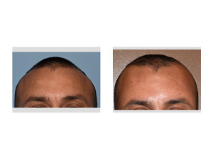 Anterior Sagittal Ridge Skull Reduction result immediate Dr Barry Eppley Indianapolis