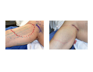 Biceps Implants Incision and Closure Dr Barry Eppley Indianapolis