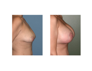 Breast Implants with Nipple Lift result side view Dr Barry Eppley Indianapolis