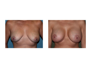 Breast Implants with Nipple Lift results front view Dr Barry Eppley Indianapolis