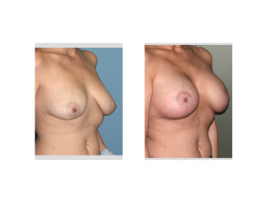 Breast Implants with Nipple Lift results oblique view Dr Barry Eppley Indianapolis