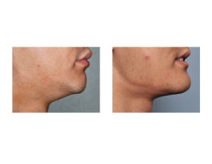 Custom Jawline Implant result side view Dr Barry Eppley Indianapolis
