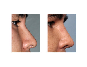 Custom Nasal Implant Replacement result side view Dr Barry Eppley Indianapolis