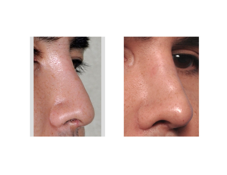 Plastic Surgery Case Study Custom Nasal Implant for Larger Dorsal