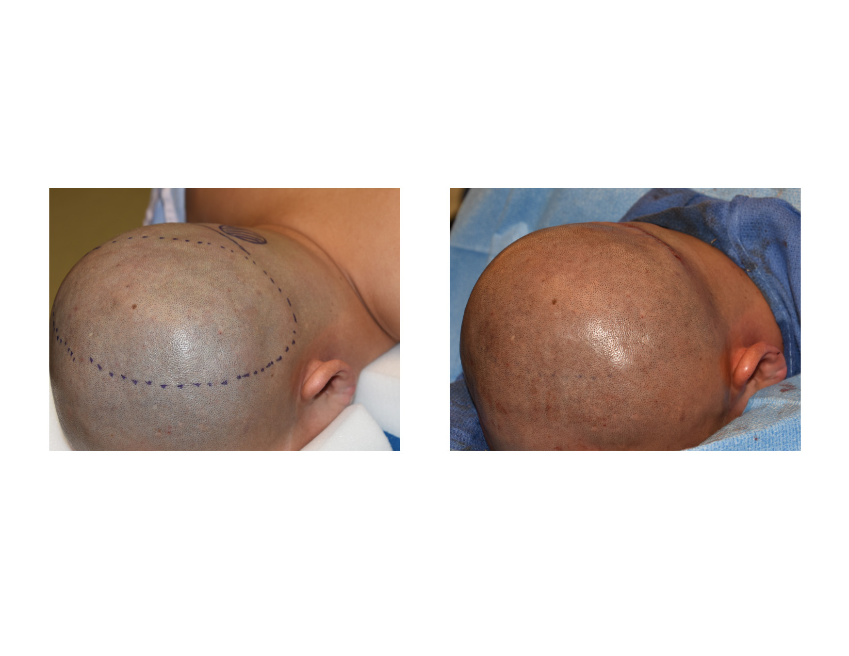 Custom Occipital Implant Intraop Immediate Result Dr Barry Eppley