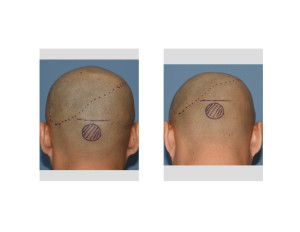 Custom Skull Implant and Occipital Knob Reduction Incision Marking Dr Barry Eppley Indianapolis