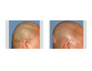 Custom Skull Implant and Occipital Knob Reduction result right side view Dr Barry Eppley Indianapolis