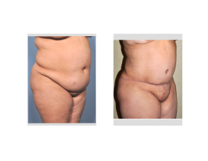 Extended Tummy Tuck of Body Lift Indianapolis Dr Barry Eppley