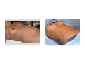 Fat Injection Breast Augmentation Indianapolis Dr Barry Eppley