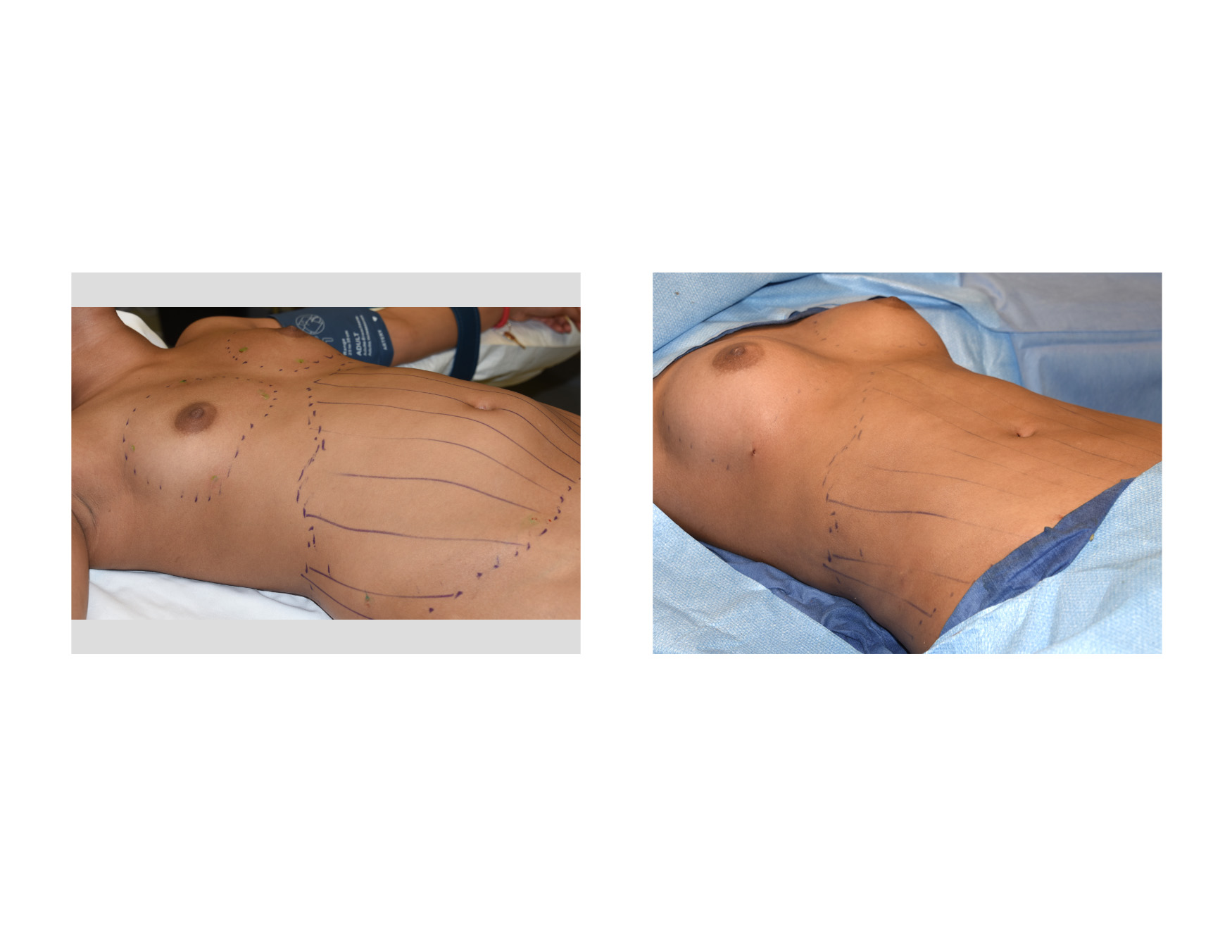 Techniques in Fat Injection Breast Augmentation - Explore Plastic Surgery