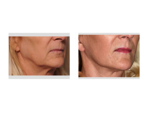 Female Lower facelift result oblique view Dr Barry Eppley Indianapolis