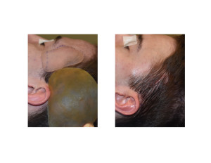 Head Widening Implants (incision closure) Dr Barry Eppley Indianapolis