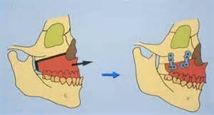 Plastic Surgery Case Study - Non-Orthodontic LeFort 1 Advancement - Explore  Plastic Surgery